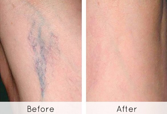 sclerotherapy
