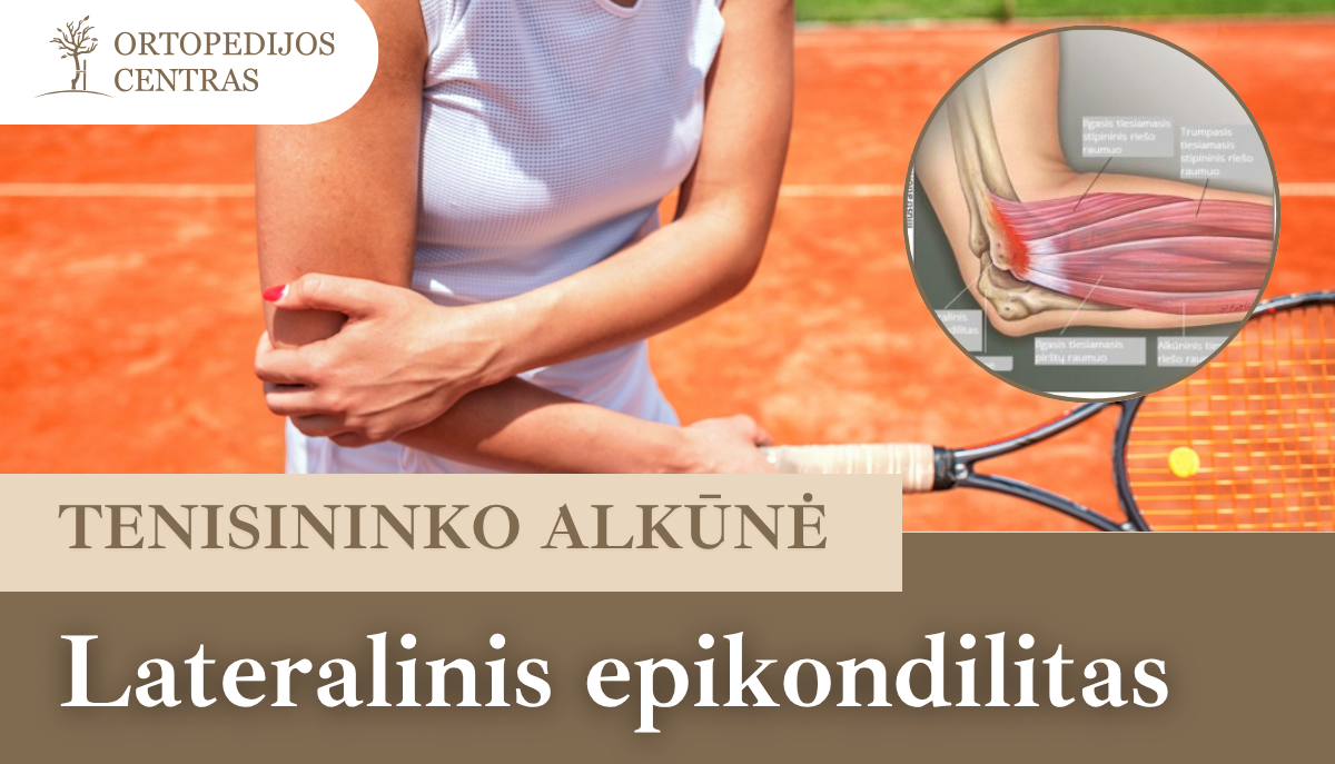 Tenisininko alkūnė - lateralinis epikondilitas 1 tenisininko-alkune