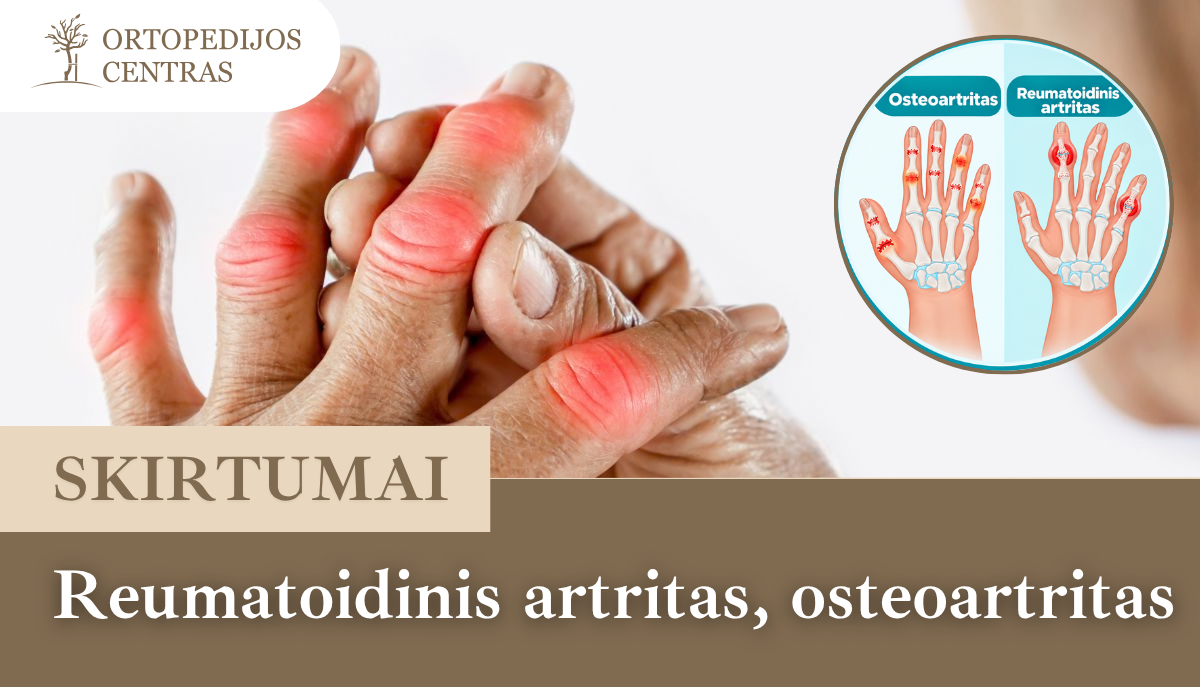 Reumatoidinis artritas osteoartritas skirtumai