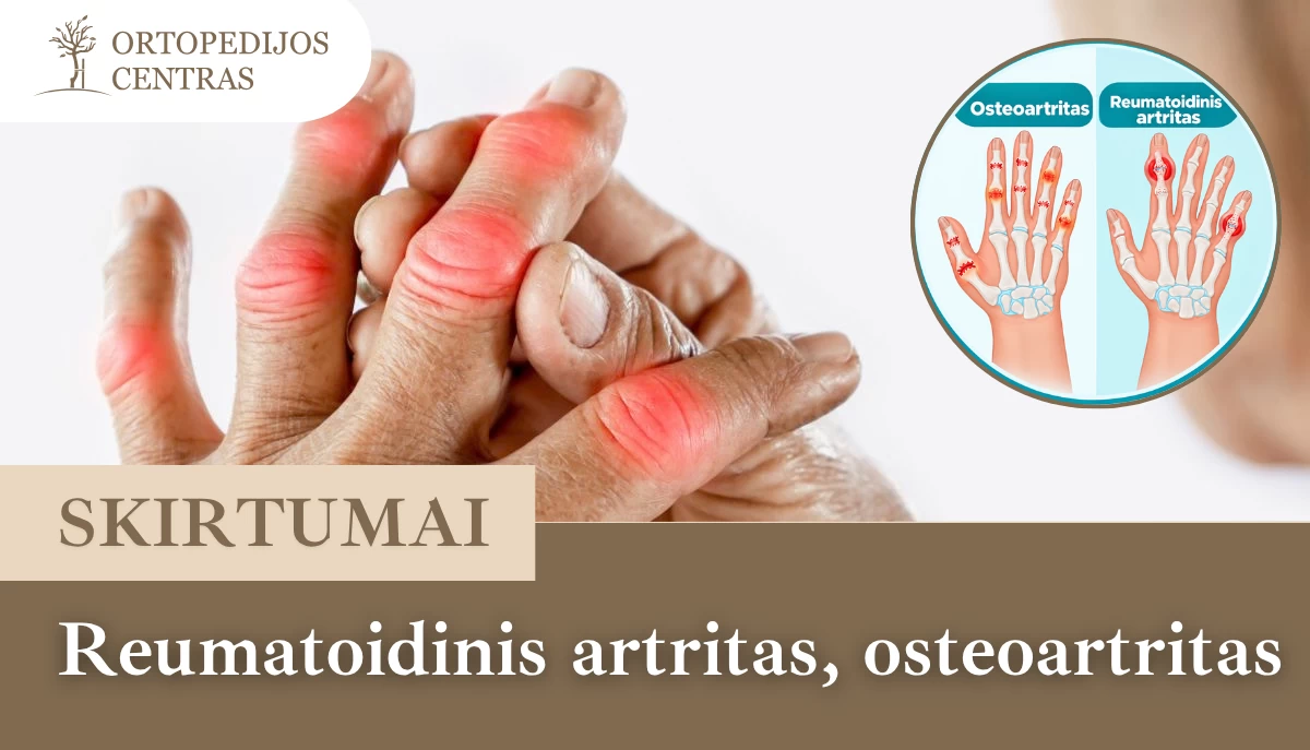 Reumatoidinis artritas osteoartritas skirtumai